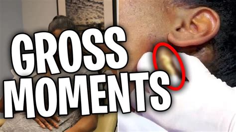 The Grossest Moments On Dr Pimple Popper That Made Us Shudder Youtube