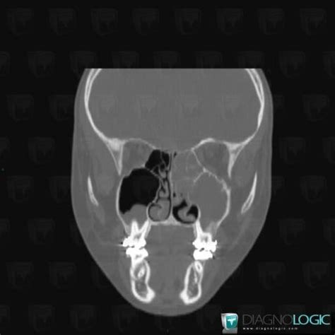 Cas Radiologie Papillome Invers Scanner Irm Diagnologic