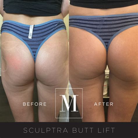 Sculptra Buttocks Enhancement — Monaco Medical Aesthetics