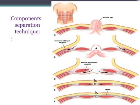 Ventral Hernias