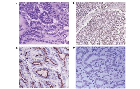 Intercellular Adhesion Molecule 1 Is A Sensitive And Diagnostically