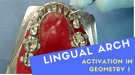 Lingual Arch Activated In Geometry I Youtube