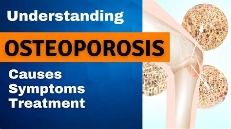 Understanding Osteoporosis Osteoporosis Causes Symptoms And