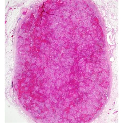 A Low Power Microscopic View Of The Accessory Spleen Showing Marked