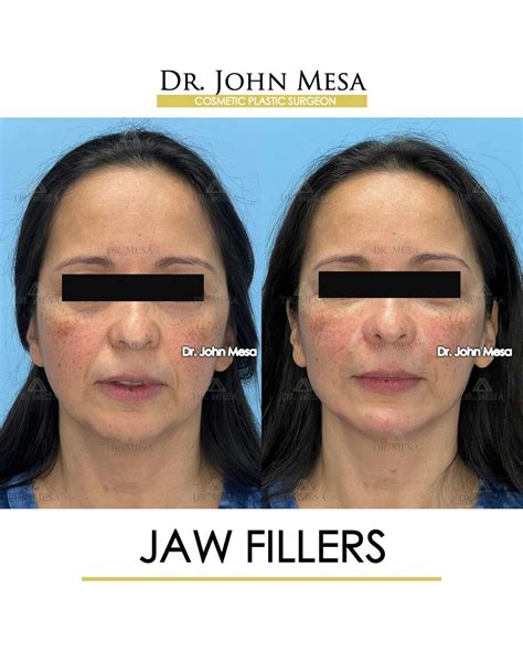 Jaw Filler Before & After Photos | Dr. Mesa