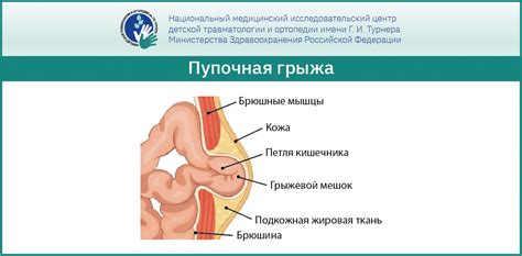 Пупочная грыжа у детей: хирургическое лечение и герниопластика в НМИЦ ...