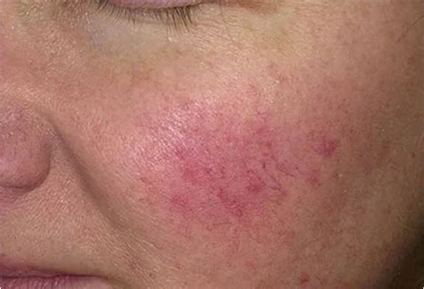 Rosacea Causes And Ways To Manage Symptoms And So Beautiful