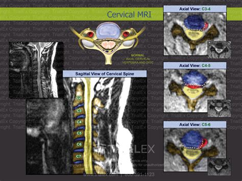 Cervical Mri Trial Exhibits Inc