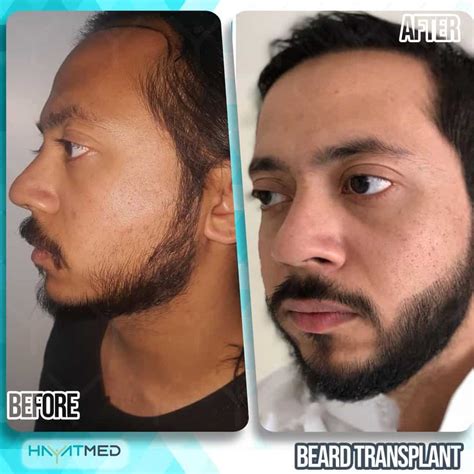 Beard Transplant In Turkey Best Scarless Results And 2024 Price