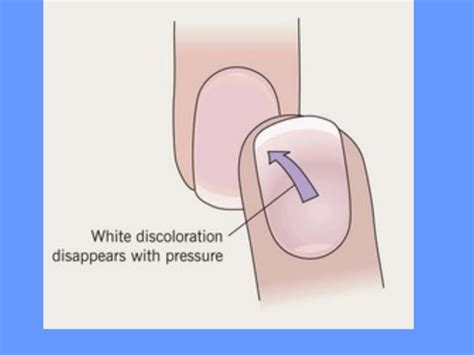 Nail Disorder Dr Aisha Almoosa Ppt