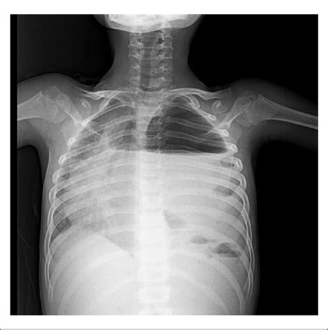 Chest X Ray Revealed A Hydro Pneumothorax With A Level Air Fluid A