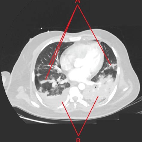 A CT Pulmonary Angiography A Bilateral Patchy Consolidation Denoting