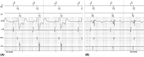 Intracardiac Electrograms A Baseline With Crt Off B Atrial Sensed