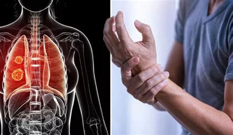 Probleme Articulare Care Ar Putea Indica Un Cancer Pulmonar