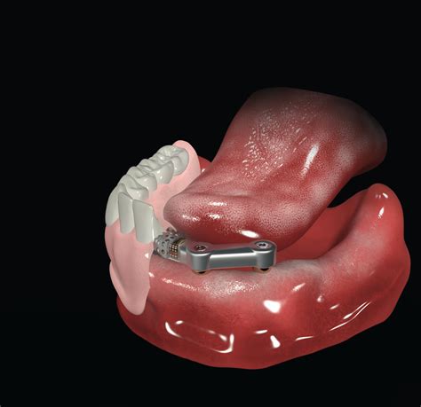 Bar-Retained Removable Overdentures (4 implants) | Megagen