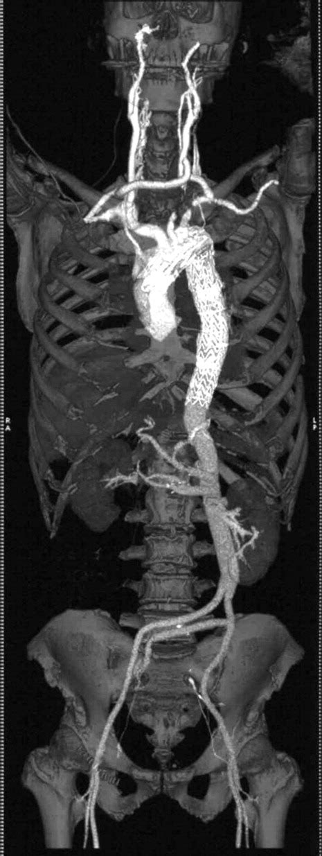 Successful Treatment Of Multiple Mycotic Aortic Aneurysms Using A