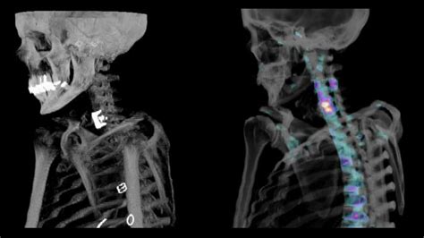 Improve Diagnostic Accuracy With XSPECT Bone SPECT CT Siemens