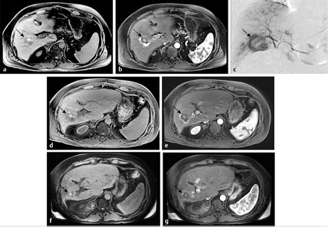 17 Management of Liver Metastases | Radiology Key