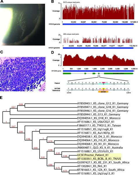 Metagenomic Deep Sequencing Of Aqueous Fluid Detects Intraocular