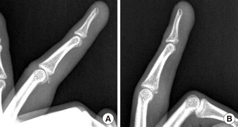 Preoperative And Follow Up Radiographs A Preoperative Radiograph B