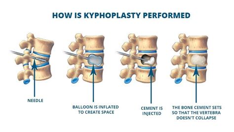 Kyphoplasty For Compression Fractures Total Spine Brain Institute