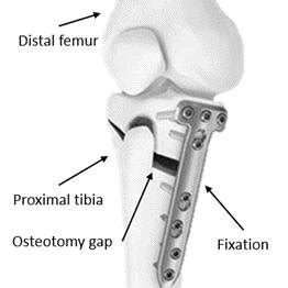 High Tibial Osteotomy And Fixation Reproduced With Permissions From