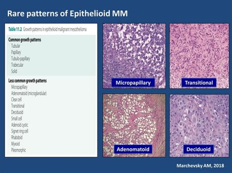 07 histology, cytology and biomarkers in pleural diseases | PPT