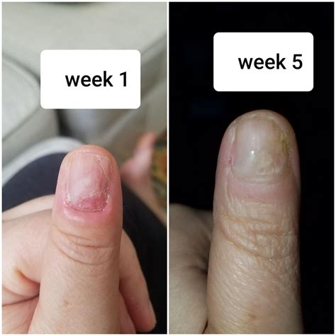 Habit tic deformity - 5 weeks, NO PICKING | Scrolller