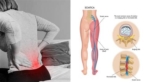 Sciatica Symptoms, Diagnosis, and Treatments - Blog