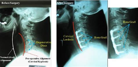 Neck Pain Treatment Centreville Va Arm Pain Cervical Stenosis