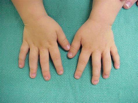 Birth Bilateral Complete Syndactyly Release With Toe Pulp Grafts For