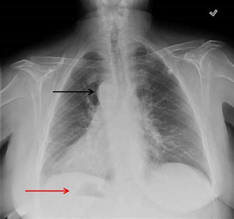 Situs inversus definition, causes, symptoms, diagnosis & treatment