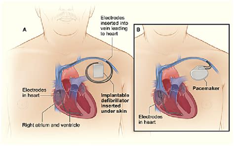 Control de desfibrilador automático implantado DAI Patient