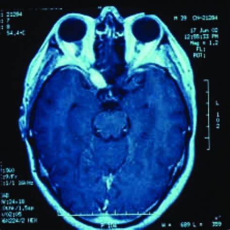 Humphrey Campimetry Of The Left Eye Showing Deterioration Of