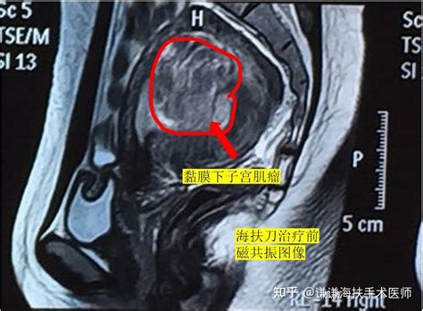 粘膜下子宫肌瘤海扶刀治疗后居然生了！ 知乎