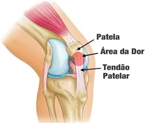 Tendinite Patelar E Dor Anterior No Joelho Causa Sintomas E Tratamentos