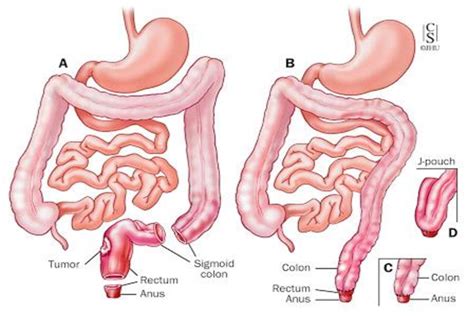 Figure 9 From Oncological And Functional Outcome Of Intersphincteric