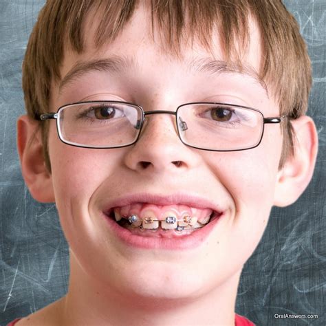 60 Photos of Teenagers with Braces | Oral Answers