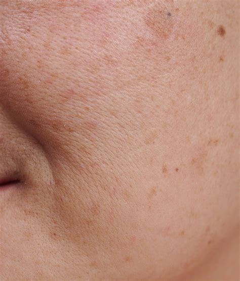 Sun Damage Treatments | Los Angeles | Refresh Med Spa LA