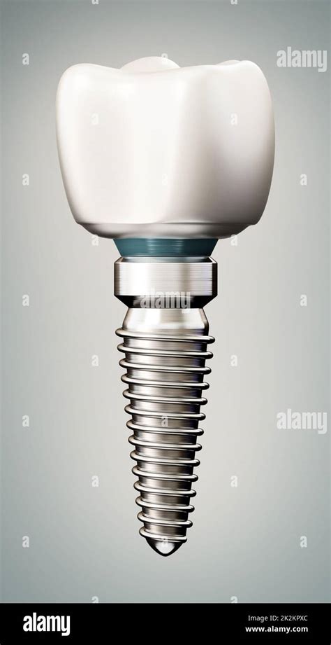 3d Rendering Of Tooth Implant 3d Illustration Stock Photo Alamy