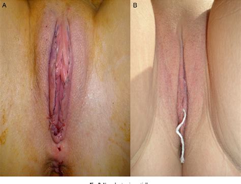 Figure 2 from Traitement de lhypertrophie des petites lèvres