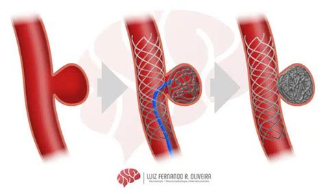 Tratamento De Aneurisma Cerebral Stent E Diversor De Fluxo