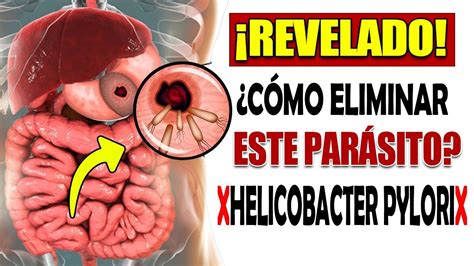 C Mo Eliminar El Helicobacter Pylori Esta Bacteria Acaba Con