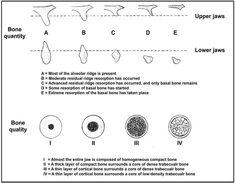 Classification Of Bone Quantity And Quality Adapted From Lekholm And