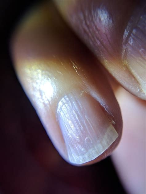 Nail Ridges Longitudinal Striations Unhas Estrias Estriadas Em 2022