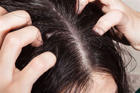 Say Goodbye To Dandruff With These Natural Kitchen Cures