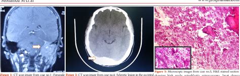 Figure 3 from Osteosarcoma of Extragnathic Skull Bones ...