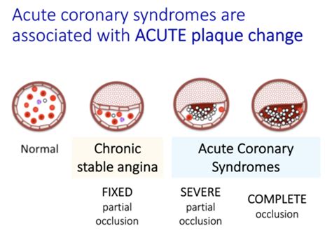 Acute Coronary Syndromes Flashcards Quizlet