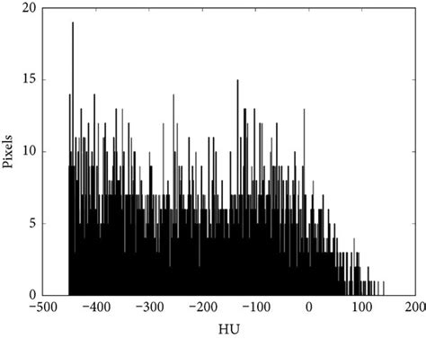 Histogram of a malignant nodule with a leptokurtic (i.e., resembling a... | Download Scientific ...