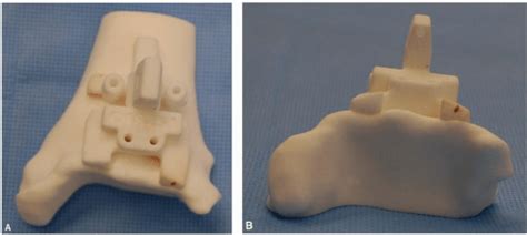 Total Ankle Arthroplasty With Prophecy® Infinity® Surgical Technique